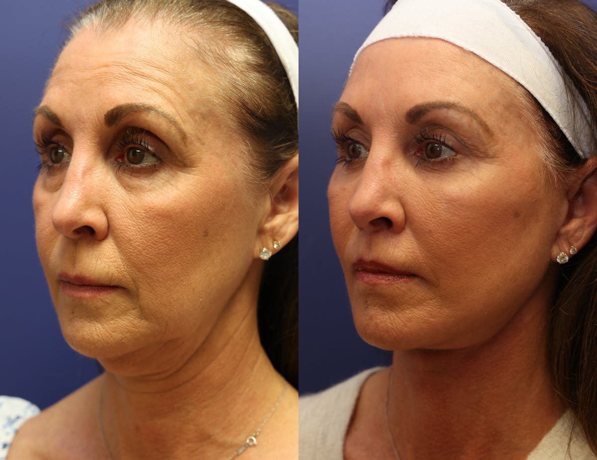 Deep Plane Facelift Before & After Gallery - Patient 343543 - Image 3