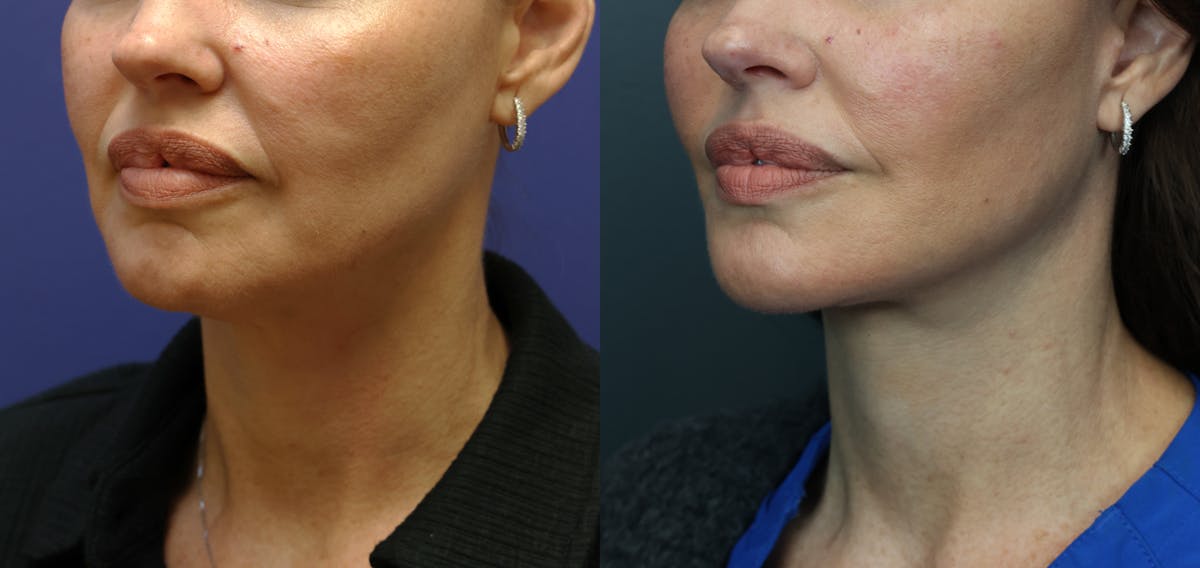 Full Facial Rejuvenation Before & After Gallery - Patient 320708 - Image 2