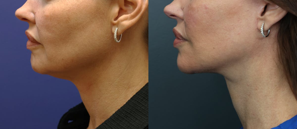 Full Facial Rejuvenation Before & After Gallery - Patient 320708 - Image 4