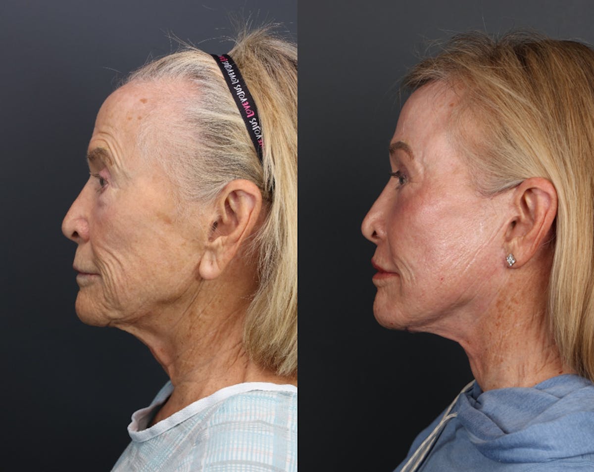 Deep Plane Facelift Before & After Gallery - Patient 520697 - Image 2