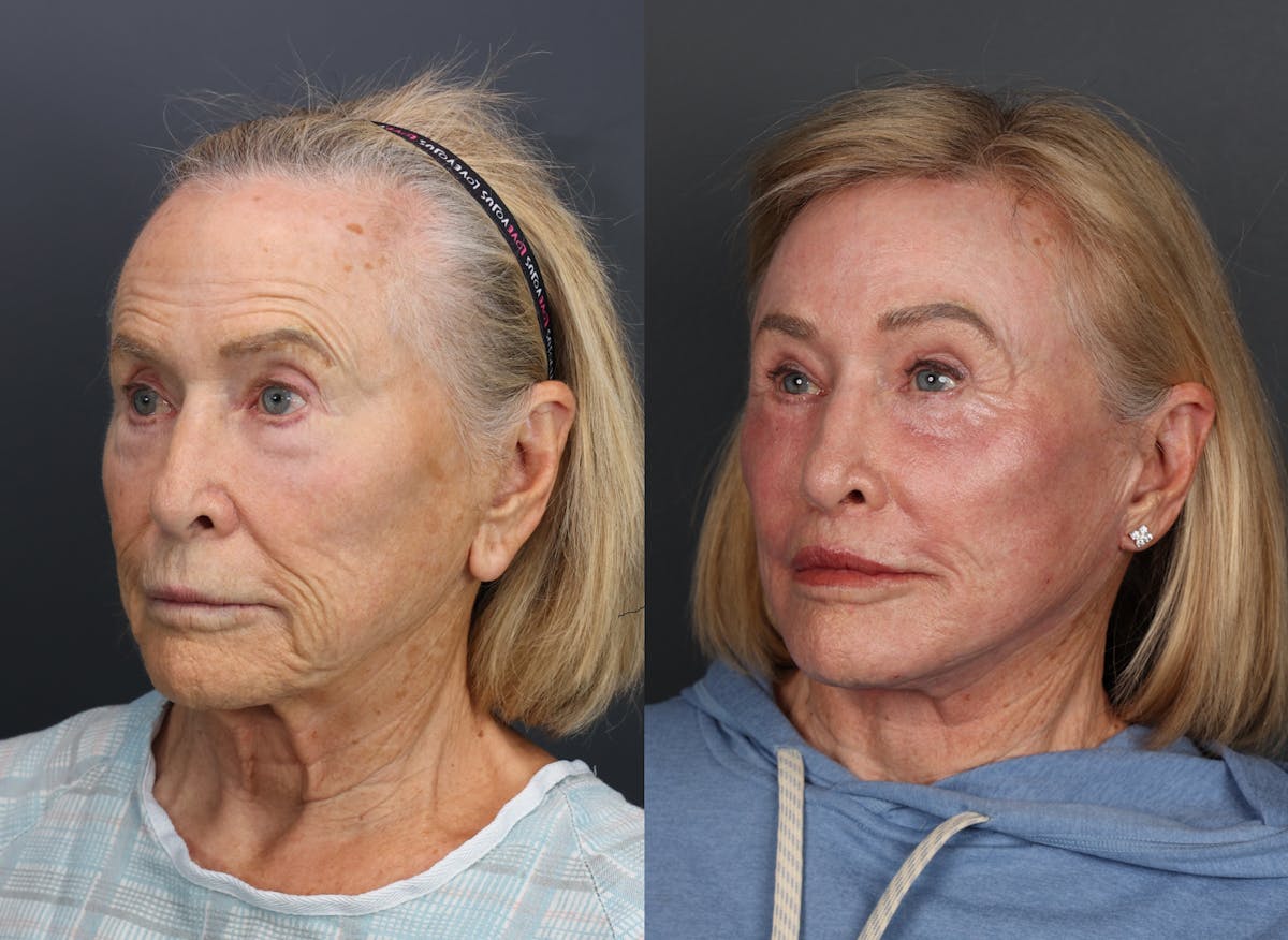 Deep Plane Facelift Before & After Gallery - Patient 520697 - Image 1