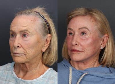 Full Facial Rejuvenation Before & After Gallery - Patient 375079 - Image 1