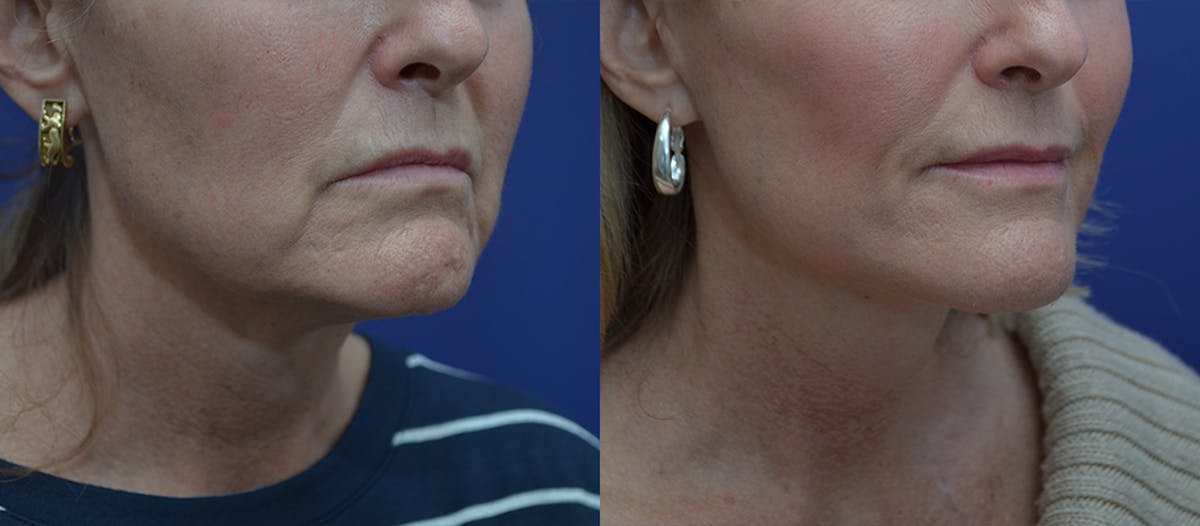 Deep Plane Facelift Before & After Gallery - Patient 106128 - Image 1