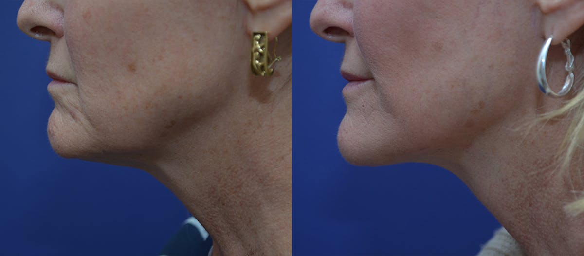 Deep Plane Facelift Before & After Gallery - Patient 106128 - Image 2