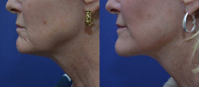Full Facial Rejuvenation Before & After Gallery - Patient 195813 - Image 2