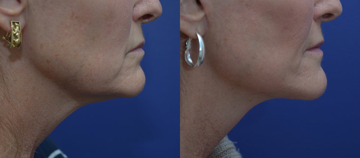 Deep Plane Facelift Before & After Gallery - Patient 106128 - Image 3