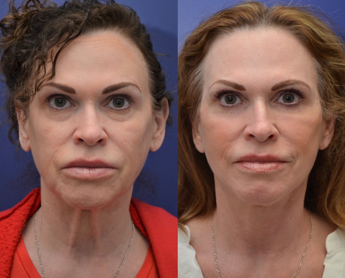 Deep Plane Facelift Before & After Gallery - Patient 350102 - Image 1