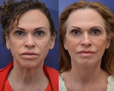 Full Facial Rejuvenation Before & After Gallery - Patient 564471 - Image 1