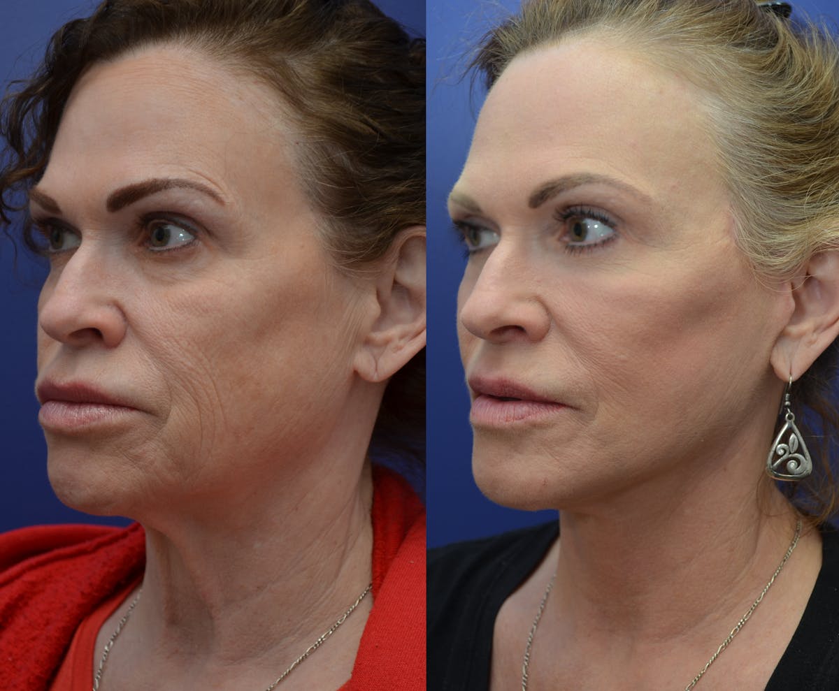 Deep Plane Facelift Before & After Gallery - Patient 350102 - Image 2