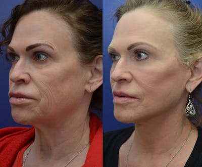 Full Facial Rejuvenation Before & After Gallery - Patient 564471 - Image 2