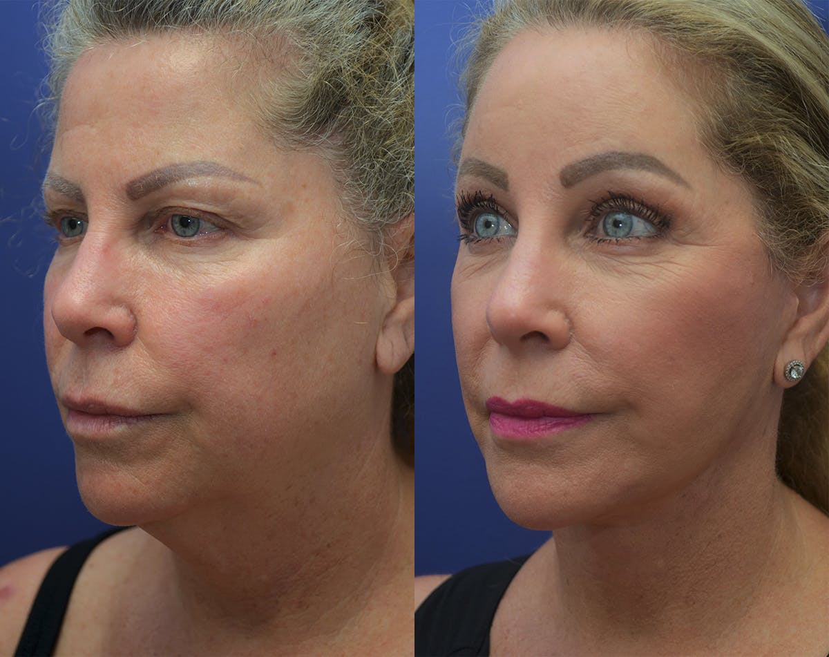 Deep Plane Facelift Before & After Gallery - Patient 248669 - Image 2