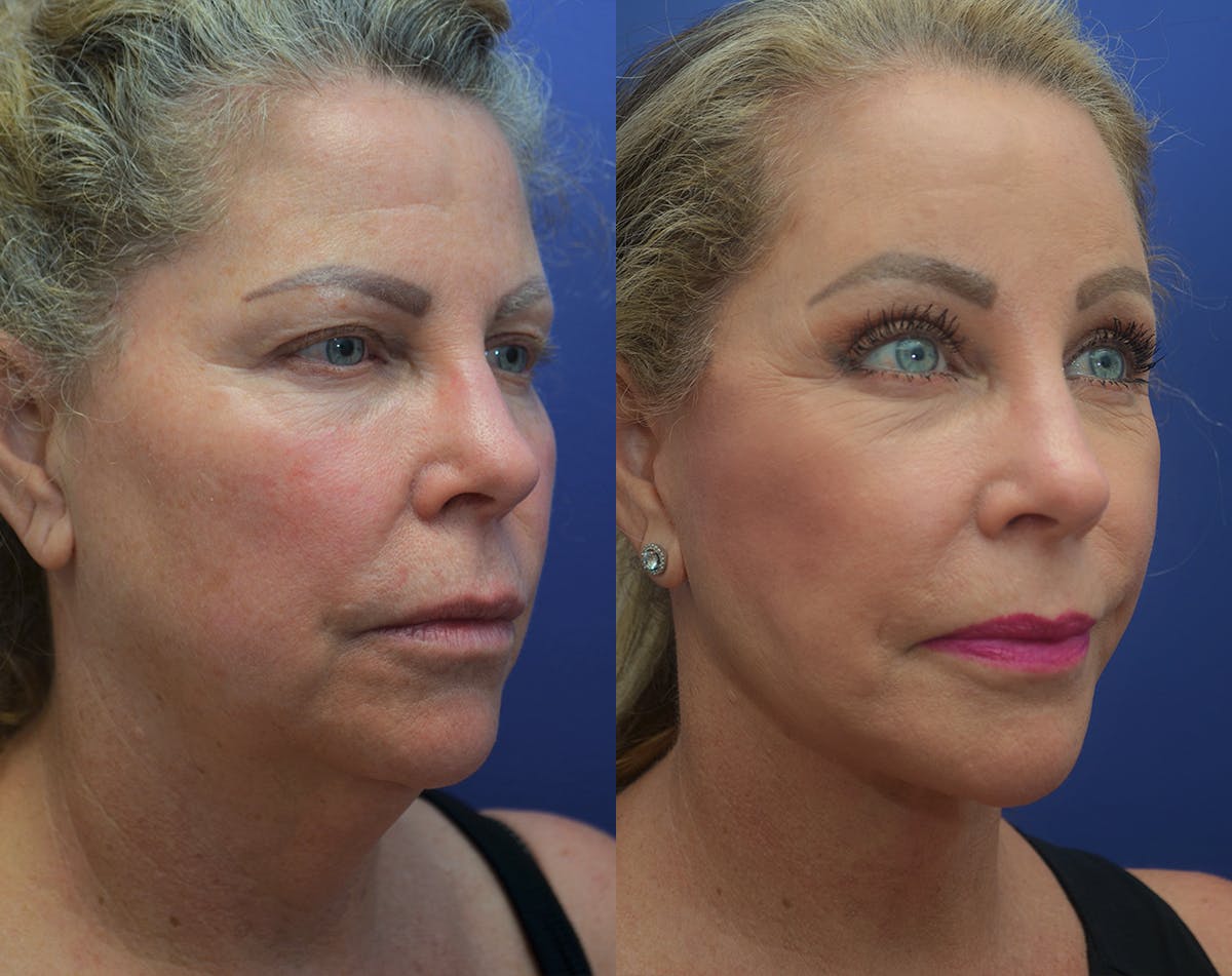 Deep Plane Facelift Before & After Gallery - Patient 248669 - Image 3