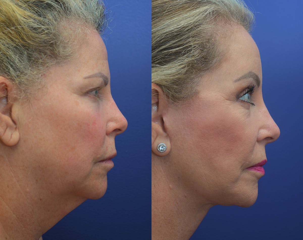 Deep Plane Facelift Before & After Gallery - Patient 248669 - Image 4