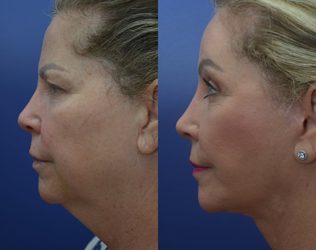 Deep Plane Facelift Before & After Gallery - Patient 248669 - Image 5