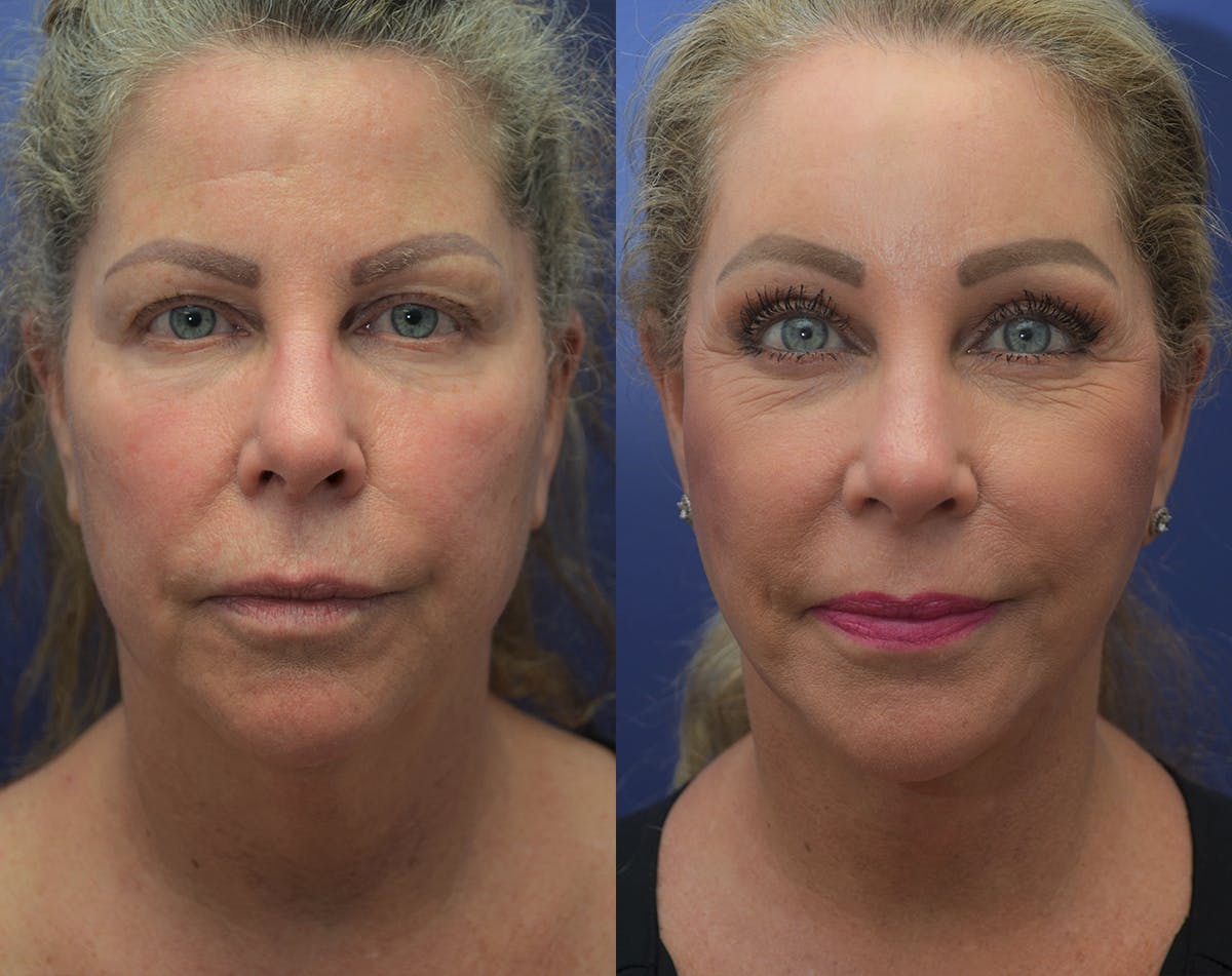 Deep Plane Facelift Before & After Gallery - Patient 248669 - Image 1