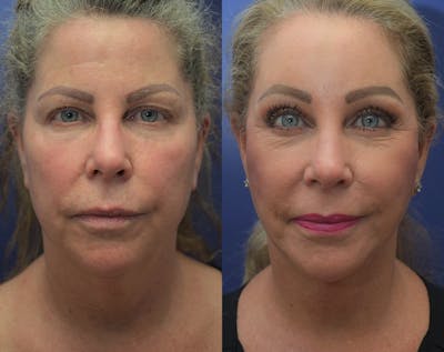 Full Facial Rejuvenation Before & After Gallery - Patient 319630 - Image 1