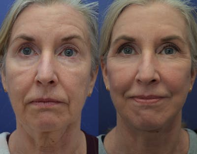 Full Facial Rejuvenation Before & After Gallery - Patient 259609 - Image 1