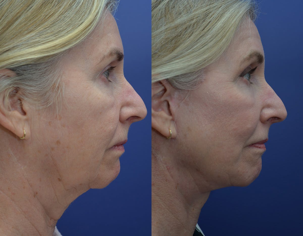 Deep Plane Facelift Before & After Gallery - Patient 179653 - Image 3