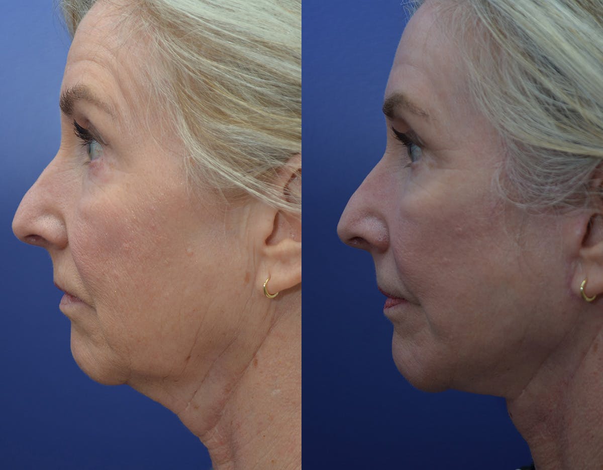 Deep Plane Facelift Before & After Gallery - Patient 179653 - Image 5