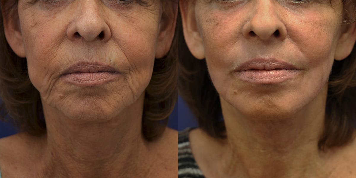 Deep Plane Facelift Before & After Gallery - Patient 139084 - Image 1