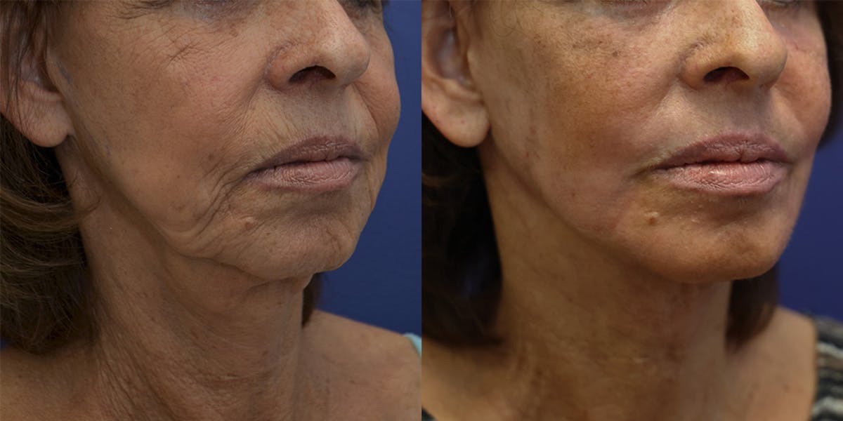 Deep Plane Facelift Before & After Gallery - Patient 139084 - Image 2