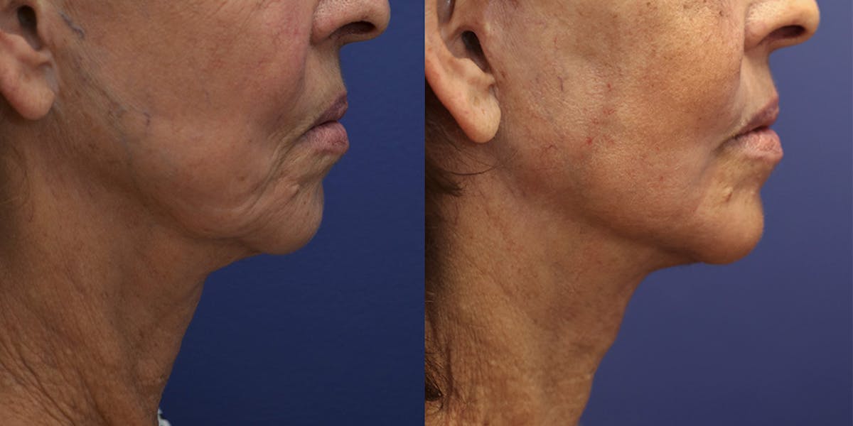 Deep Plane Facelift Before & After Gallery - Patient 139084 - Image 3