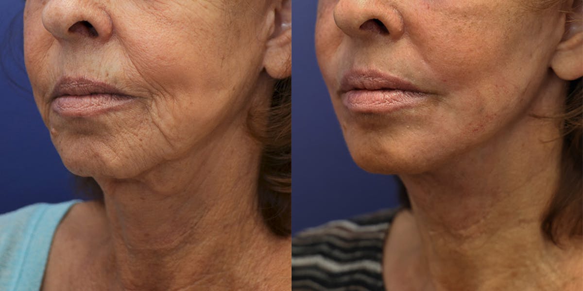 Deep Plane Facelift Before & After Gallery - Patient 139084 - Image 4