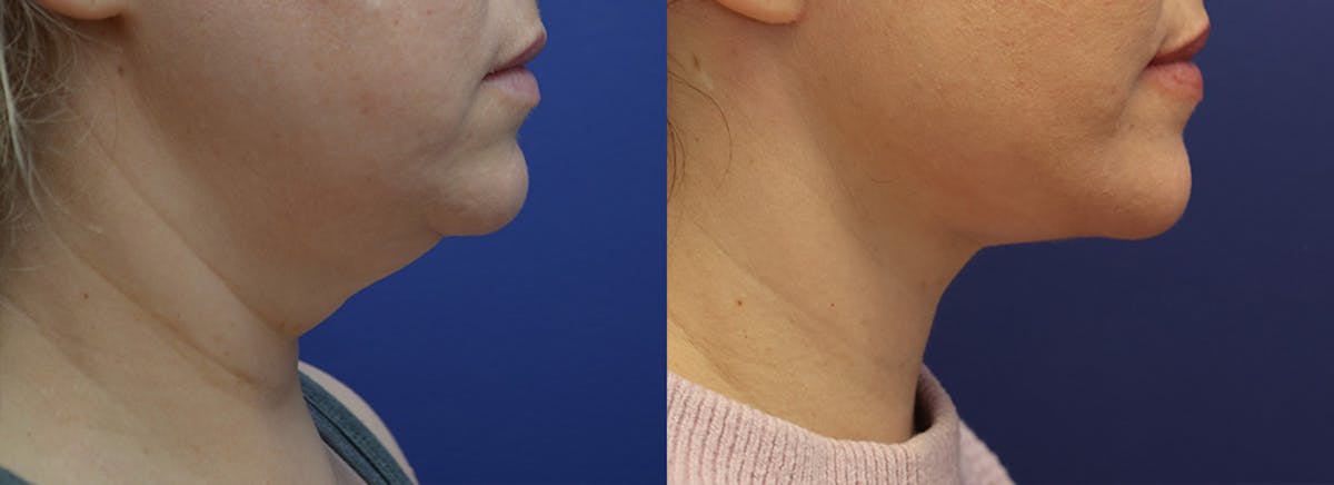 Deep Plane Facelift Before & After Gallery - Patient 231403 - Image 1