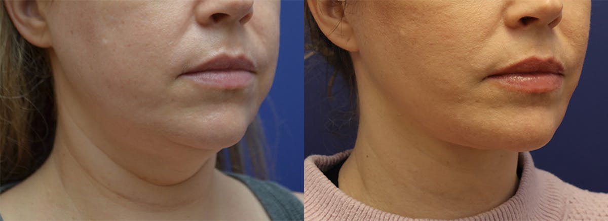 Deep Plane Facelift Before & After Gallery - Patient 231403 - Image 2