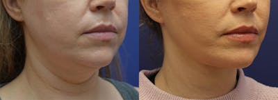 Full Facial Rejuvenation Before & After Gallery - Patient 119444 - Image 2