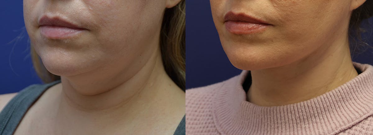 Deep Plane Facelift Before & After Gallery - Patient 231403 - Image 3