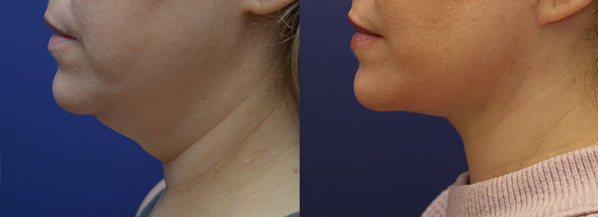 Deep Plane Facelift Before & After Gallery - Patient 231403 - Image 4