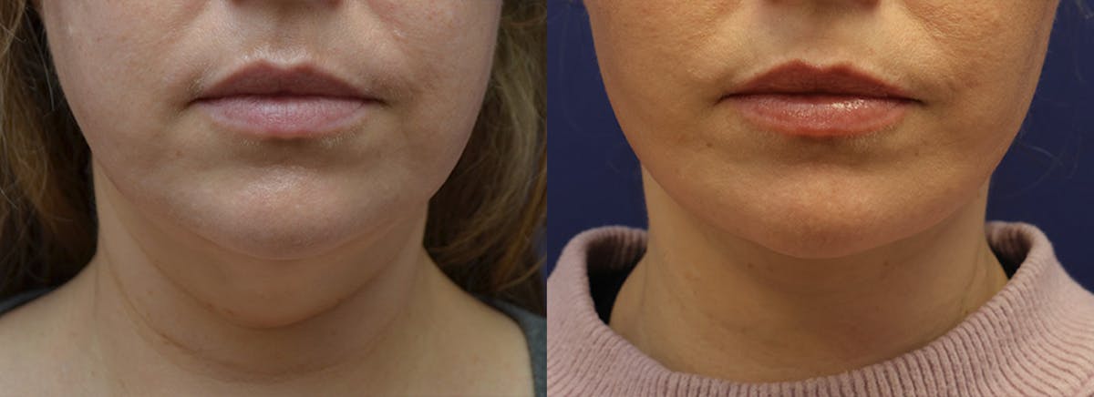 Deep Plane Facelift Before & After Gallery - Patient 231403 - Image 5