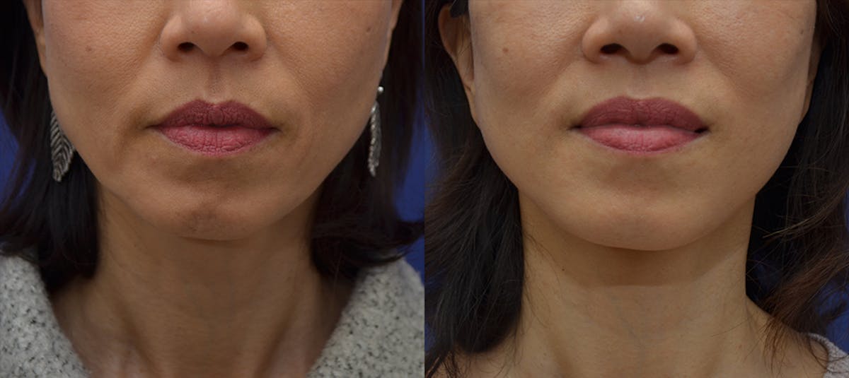 Deep Plane Facelift Before & After Gallery - Patient 269731 - Image 1