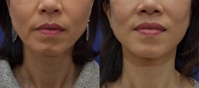 Full Facial Rejuvenation Before & After Gallery - Patient 323727 - Image 1