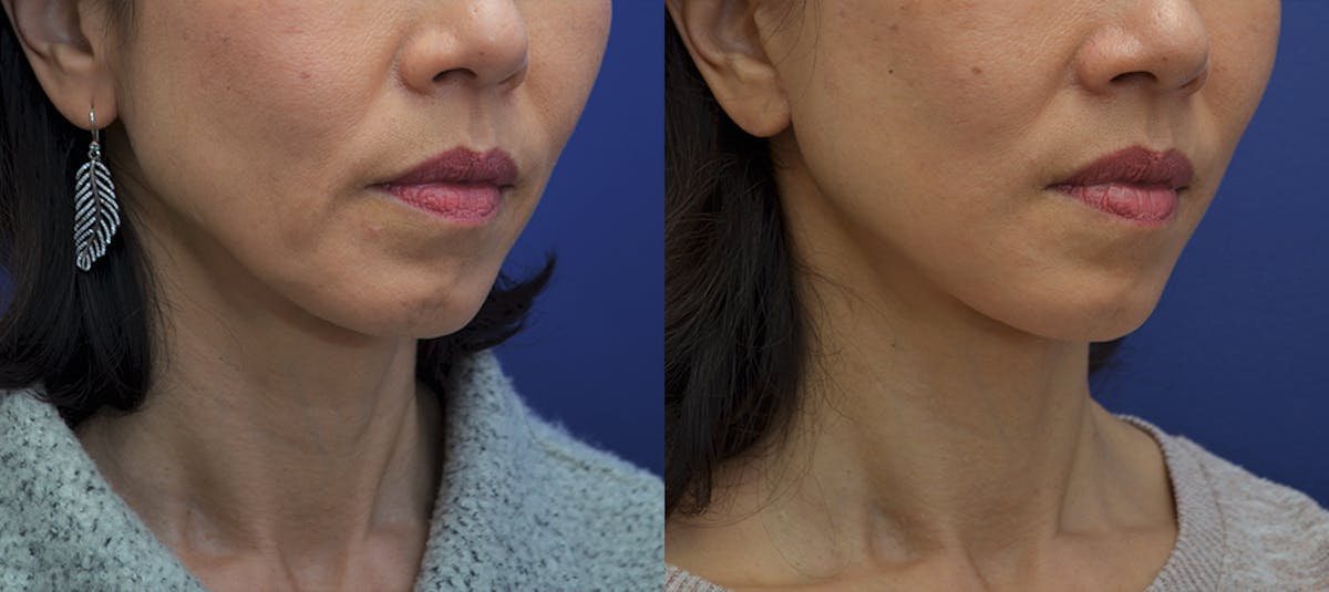 Deep Plane Facelift Before & After Gallery - Patient 269731 - Image 2