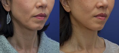Full Facial Rejuvenation Before & After Gallery - Patient 323727 - Image 2