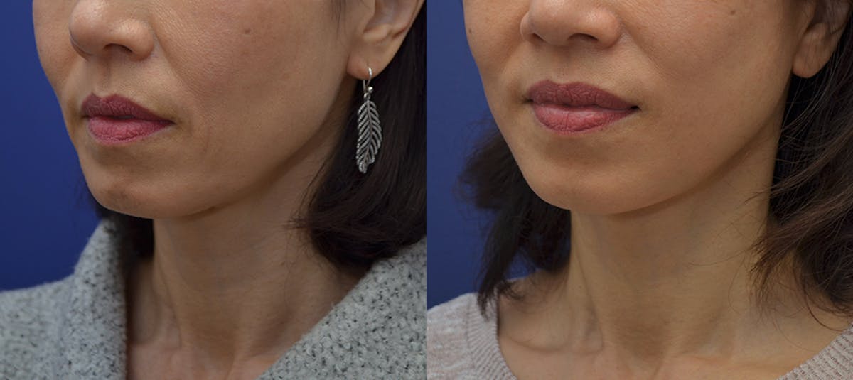 Deep Plane Facelift Before & After Gallery - Patient 269731 - Image 3