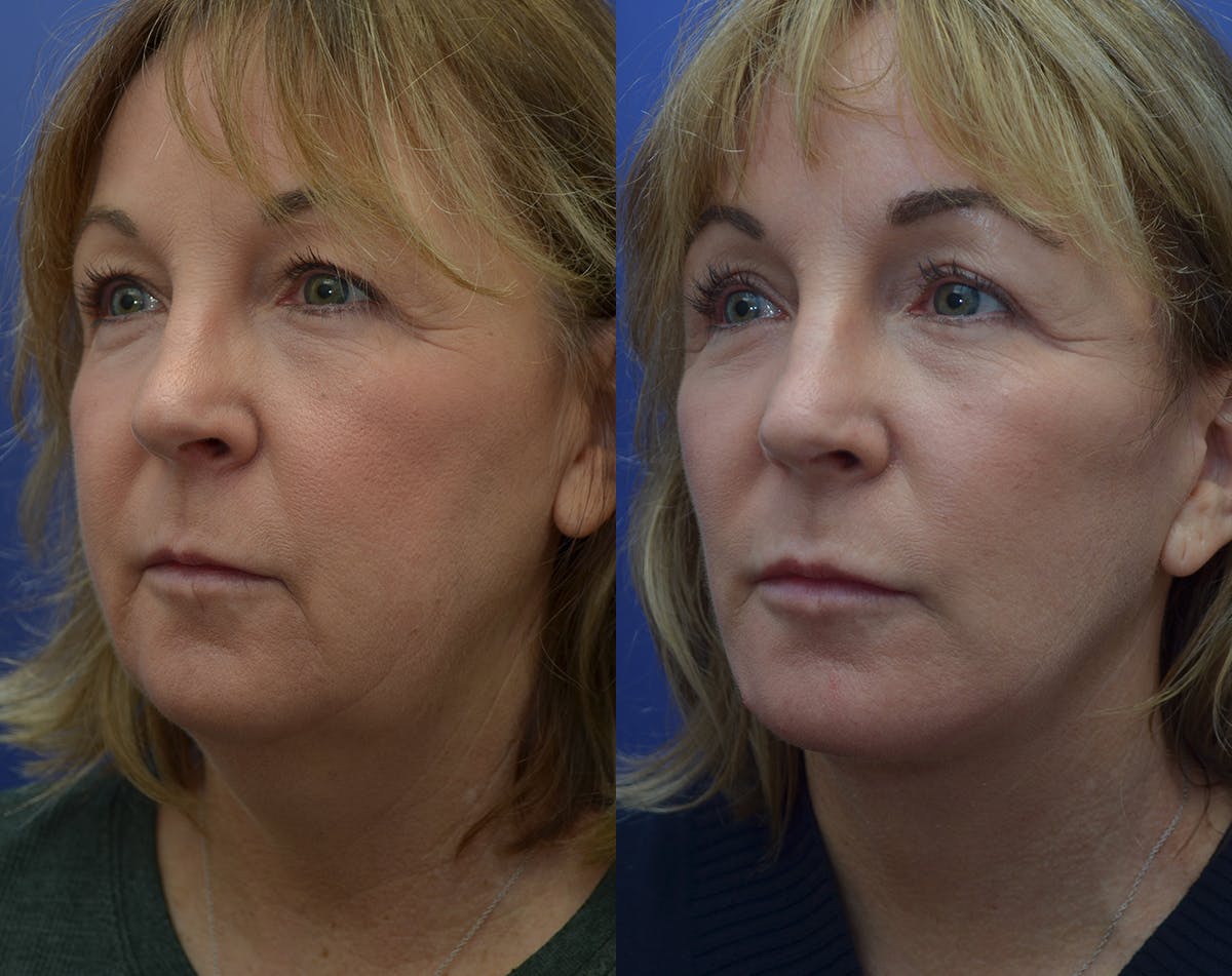 Deep Plane Facelift Before & After Gallery - Patient 983406 - Image 2