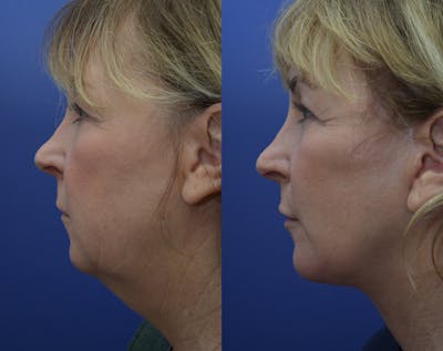 Full Facial Rejuvenation Before & After Gallery - Patient 693288 - Image 1