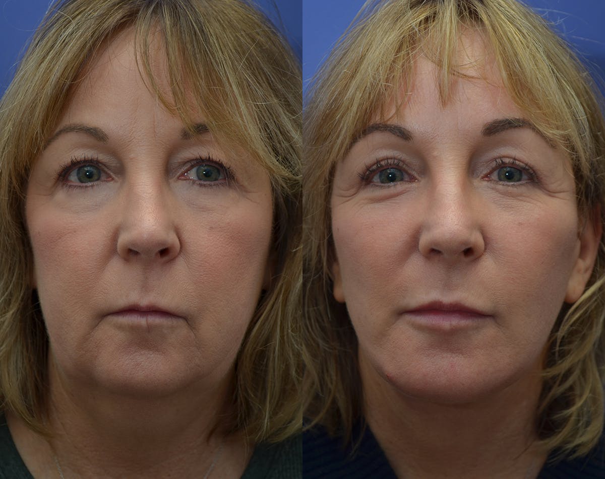 Deep Plane Facelift Before & After Gallery - Patient 983406 - Image 1