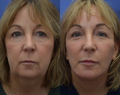 Full Facial Rejuvenation Before & After Gallery - Patient 389622 - Image 1