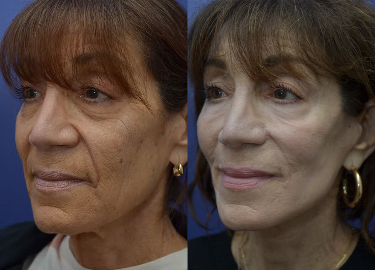 Full Facial Rejuvenation Before & After Gallery - Patient 246637 - Image 2