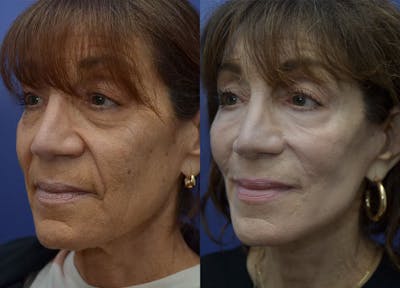 Full Facial Rejuvenation Before & After Gallery - Patient 246637 - Image 2