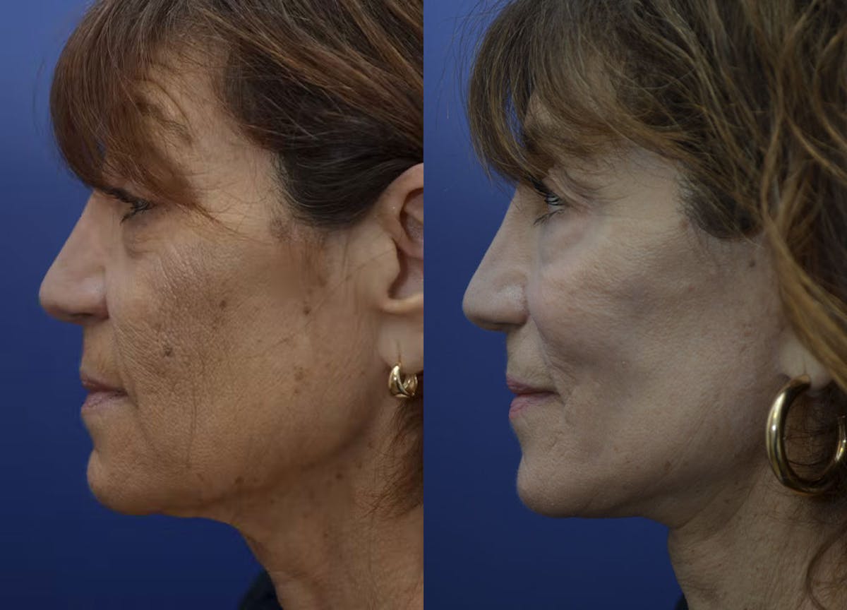 Full Facial Rejuvenation Before & After Gallery - Patient 246637 - Image 3