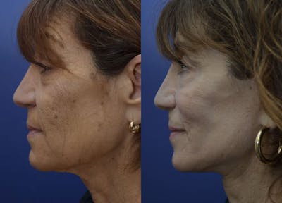 Full Facial Rejuvenation Before & After Gallery - Patient 428438 - Image 2