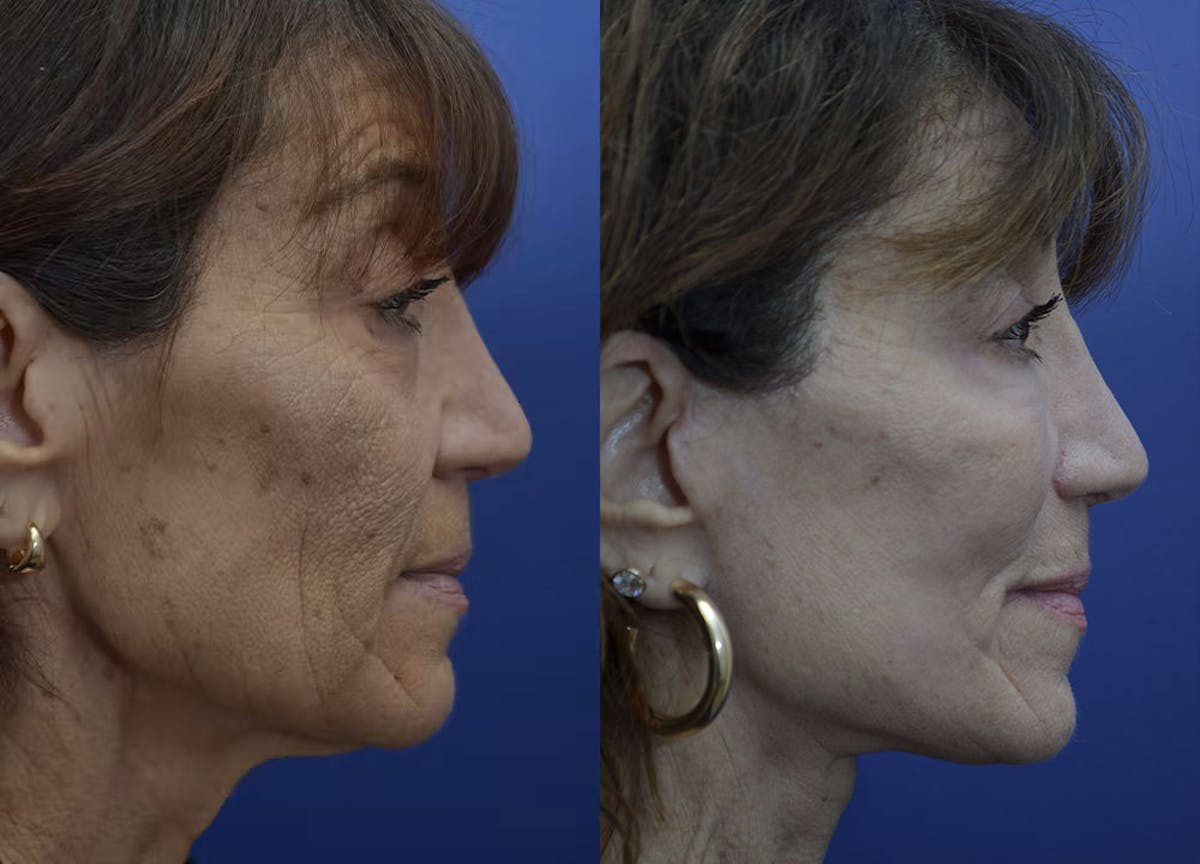 Full Facial Rejuvenation Before & After Gallery - Patient 246637 - Image 4
