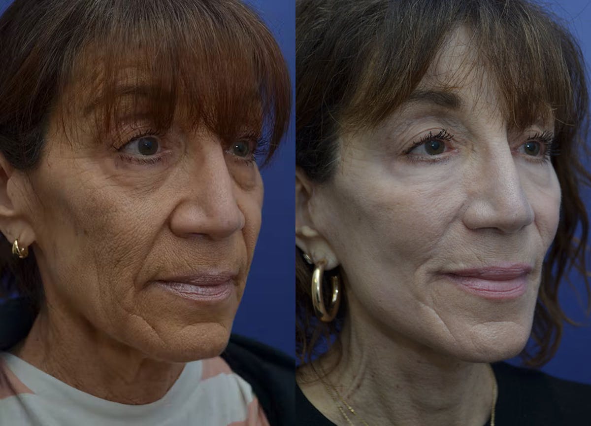 Full Facial Rejuvenation Before & After Gallery - Patient 246637 - Image 5