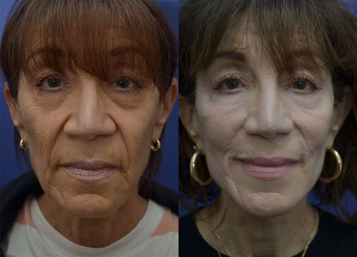 Full Facial Rejuvenation Before & After Gallery - Patient 246637 - Image 1