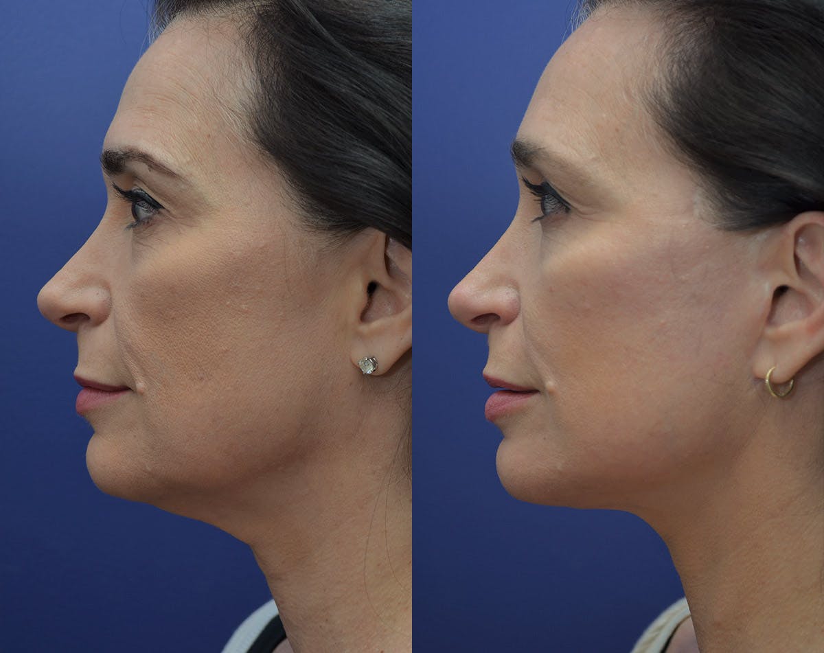 Deep Plane Facelift Before & After Gallery - Patient 173407 - Image 5